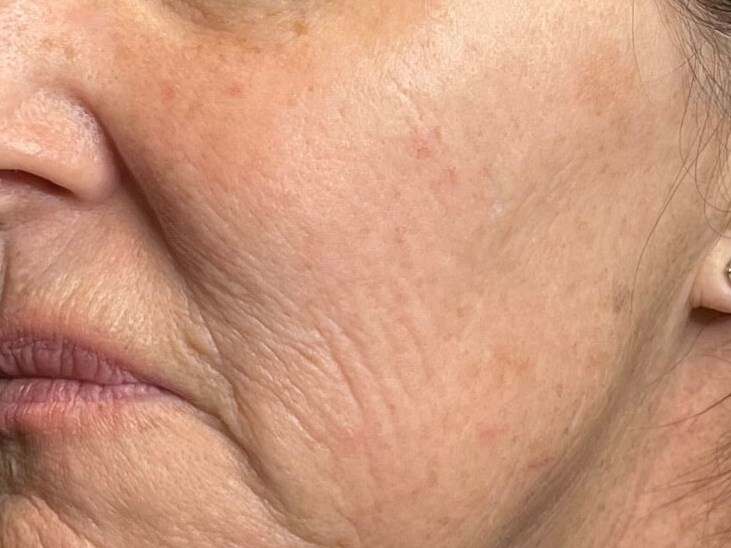 Halo Laser skin resurfacing After