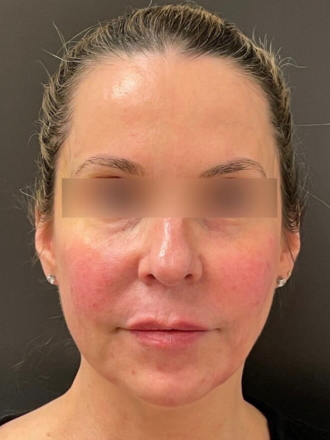 Juvederm Face Enhancement After