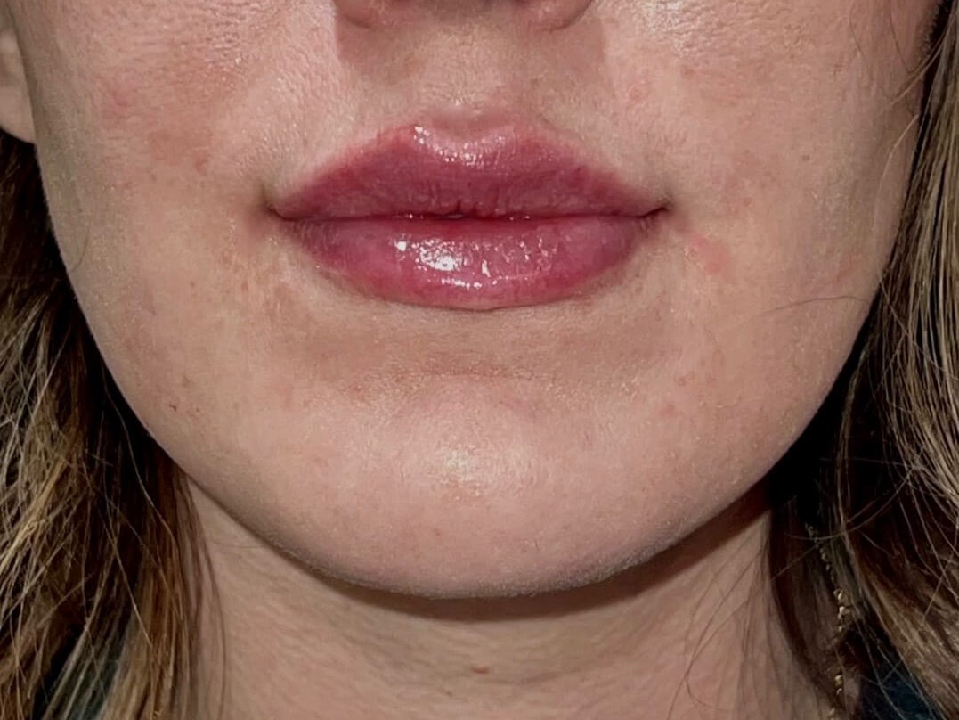 Juvederm Lip Enhancement After