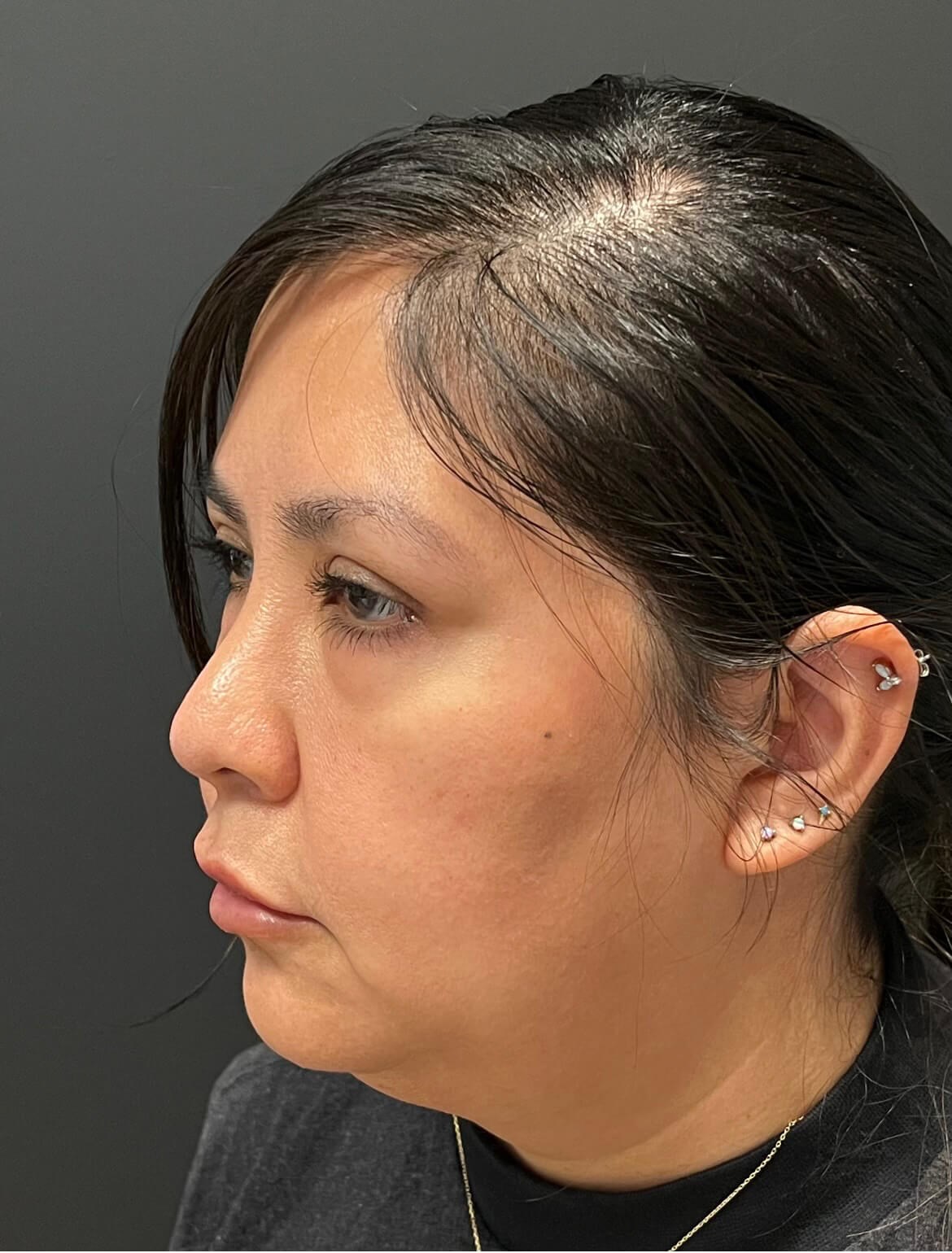 CoolSculpting  Chin Before