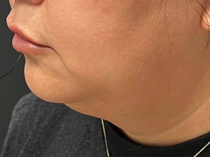 CoolSculpting  Chin Before