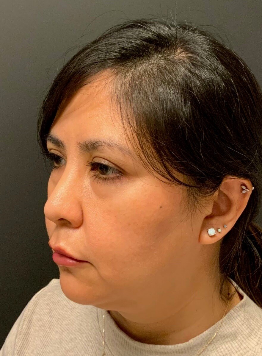 CoolSculpting  Chin After