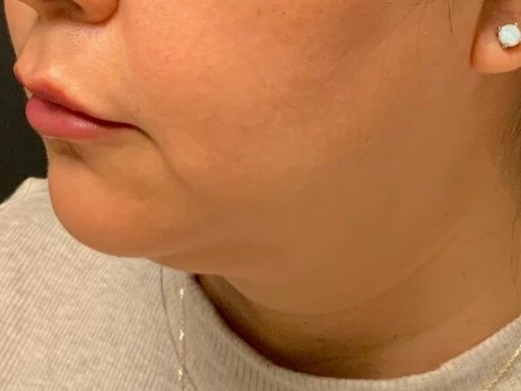 CoolSculpting  Chin After