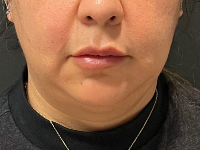 CoolSculpting  Chin Before