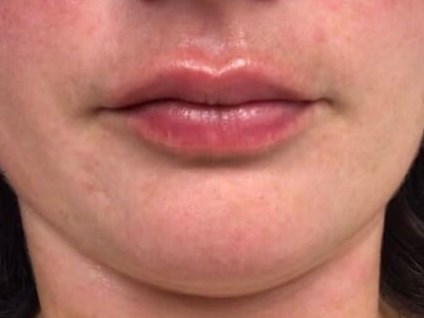 Juvederm Lip Enhancement After