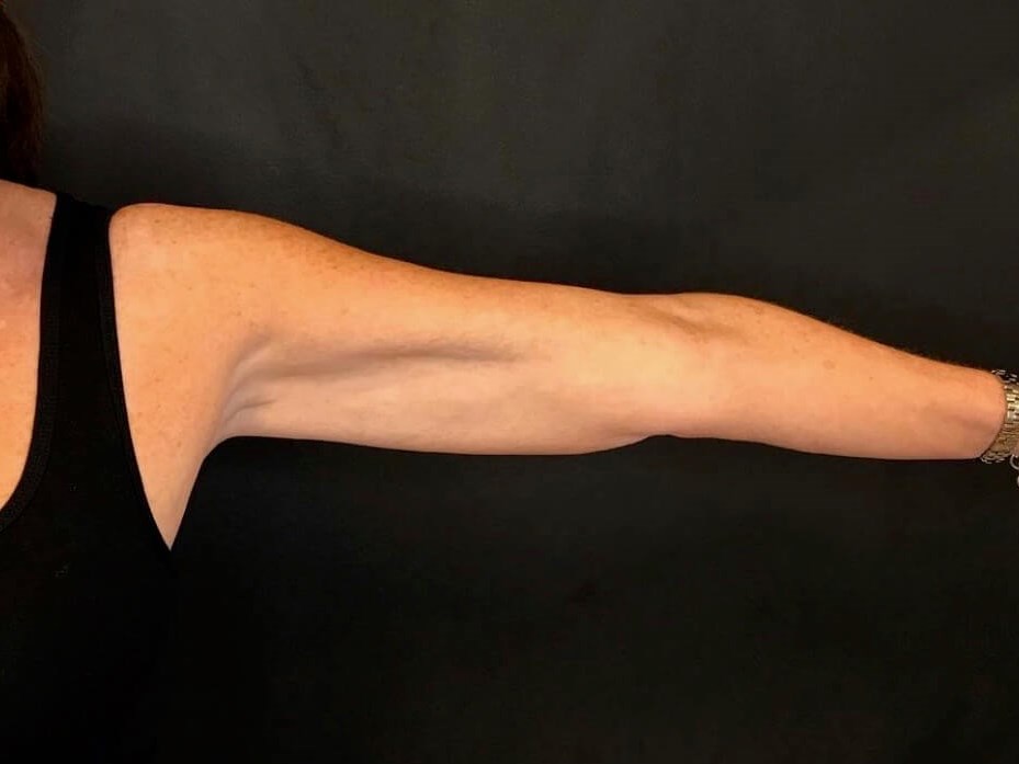 CoolSculpting Arms After