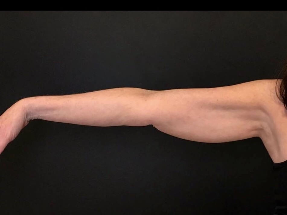 CoolSculpting Arms Before