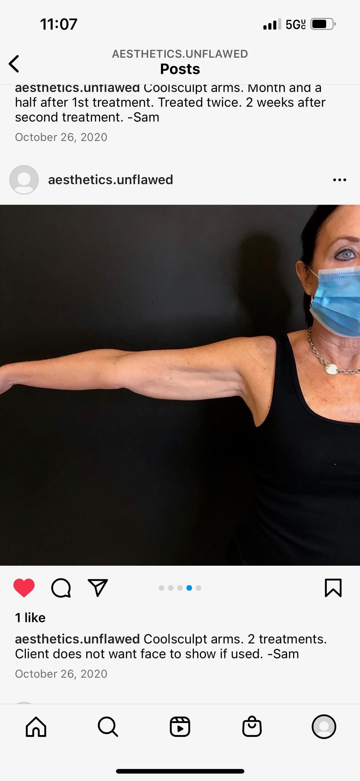 CoolSculpting Arms After