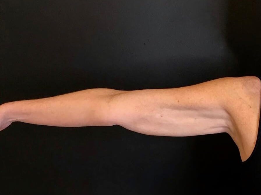 CoolSculpting Arms After