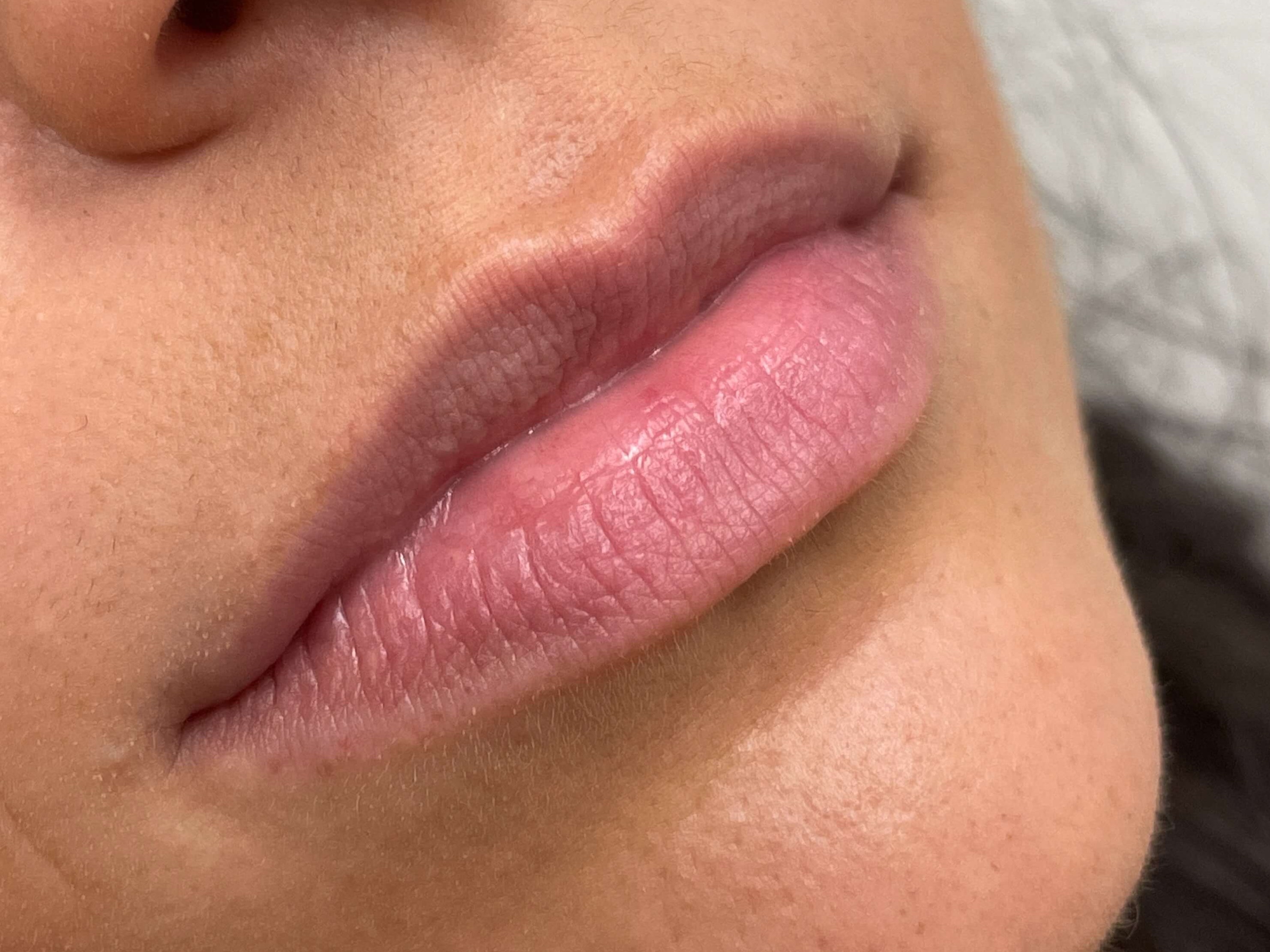 Juvederm Lip Enhancement Before