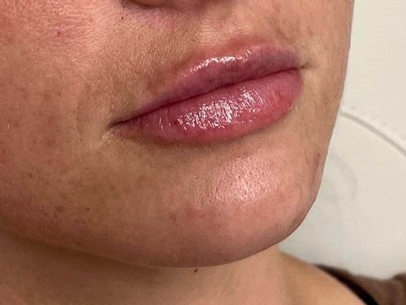 Juvederm Lip Enhancement After