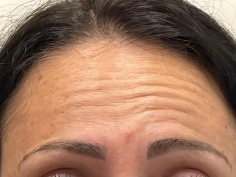 Botox forehead Before
