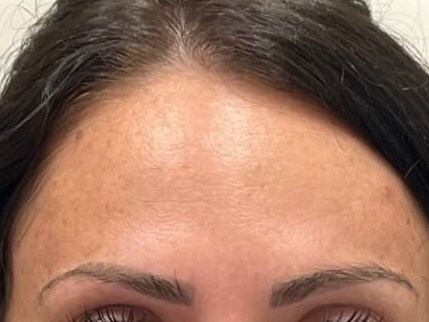 Botox forehead After