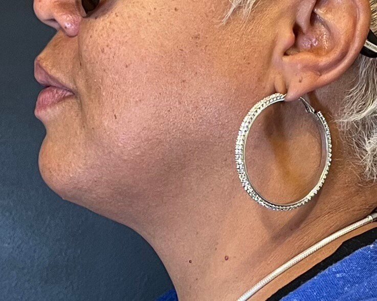 CoolSculpting  Chin After