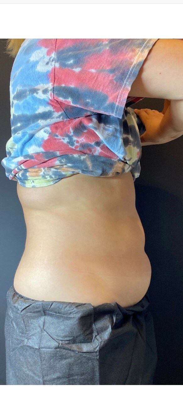 CoolSculpting Abdomen Before