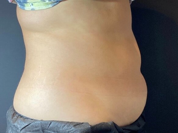 CoolSculpting Abdomen Before