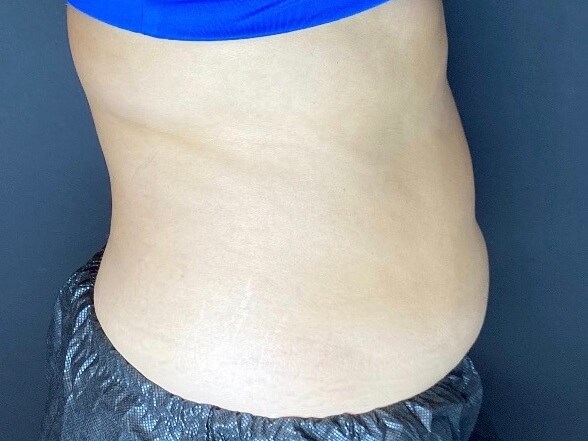 CoolSculpting Abdomen After