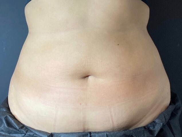 CoolSculpting Abdomen Before
