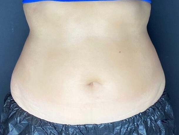 CoolSculpting Abdomen After