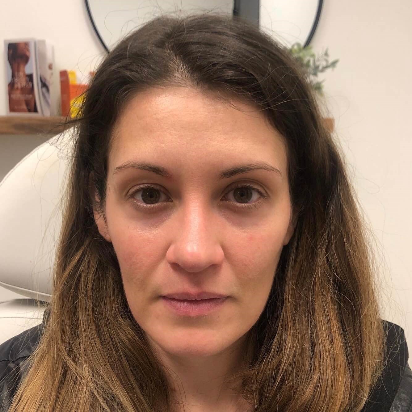 Sculptra Facial Enhancement Before