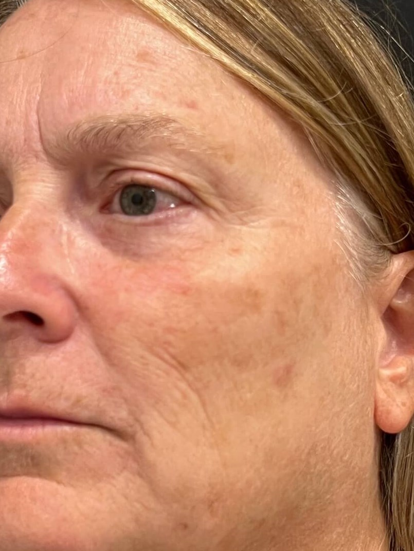 BBL Photo Facial After