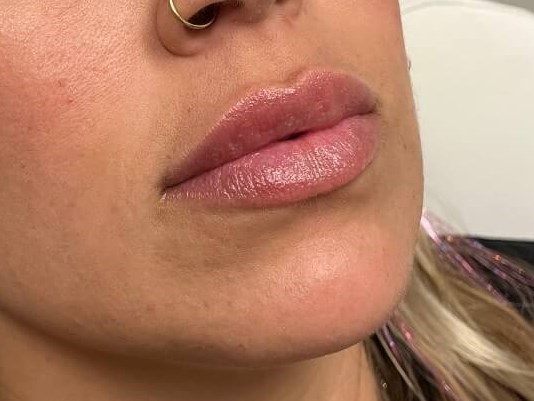 Juvederm Lip Enhancement After
