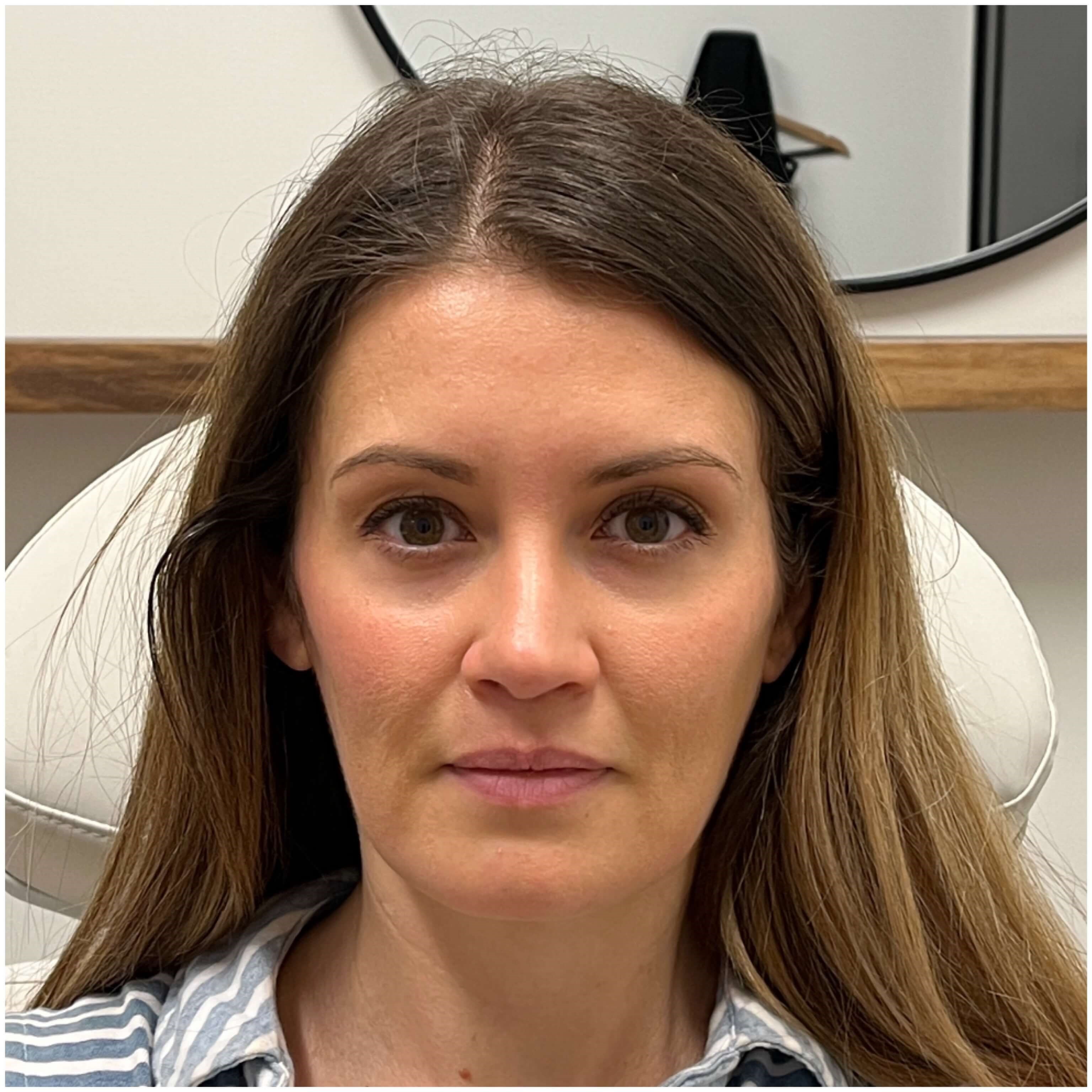 Sculptra Facial Enhancement After