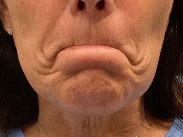 Botox Chin Before