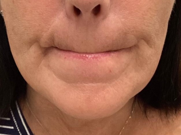 Botox Chin After