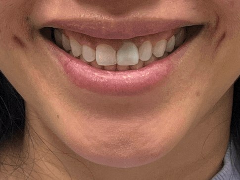 Botox Gummy Smile Before