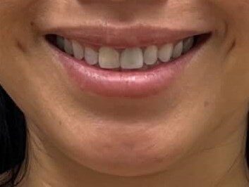 Botox Gummy Smile After