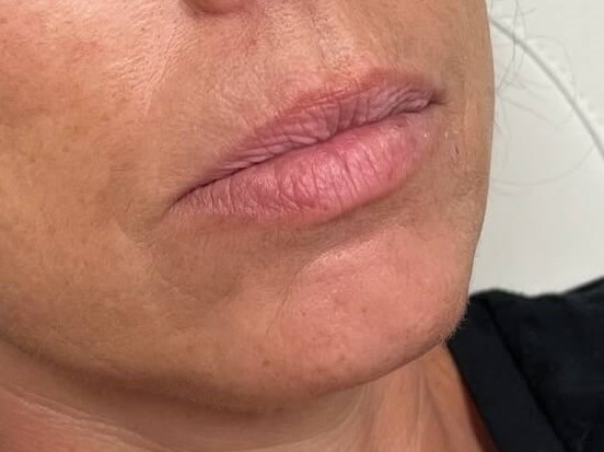 Juvederm Lip Enhancement Before