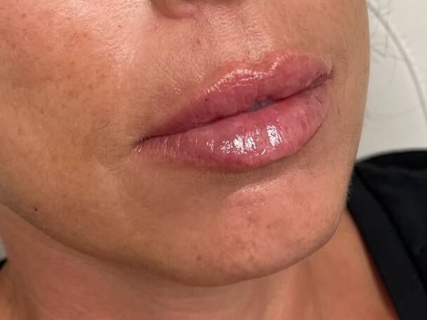 Juvederm Lip Enhancement After