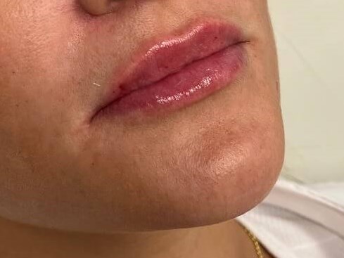 Juvederm Lip Enhancement After