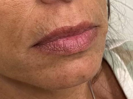Juvederm Lip Enhancement Before