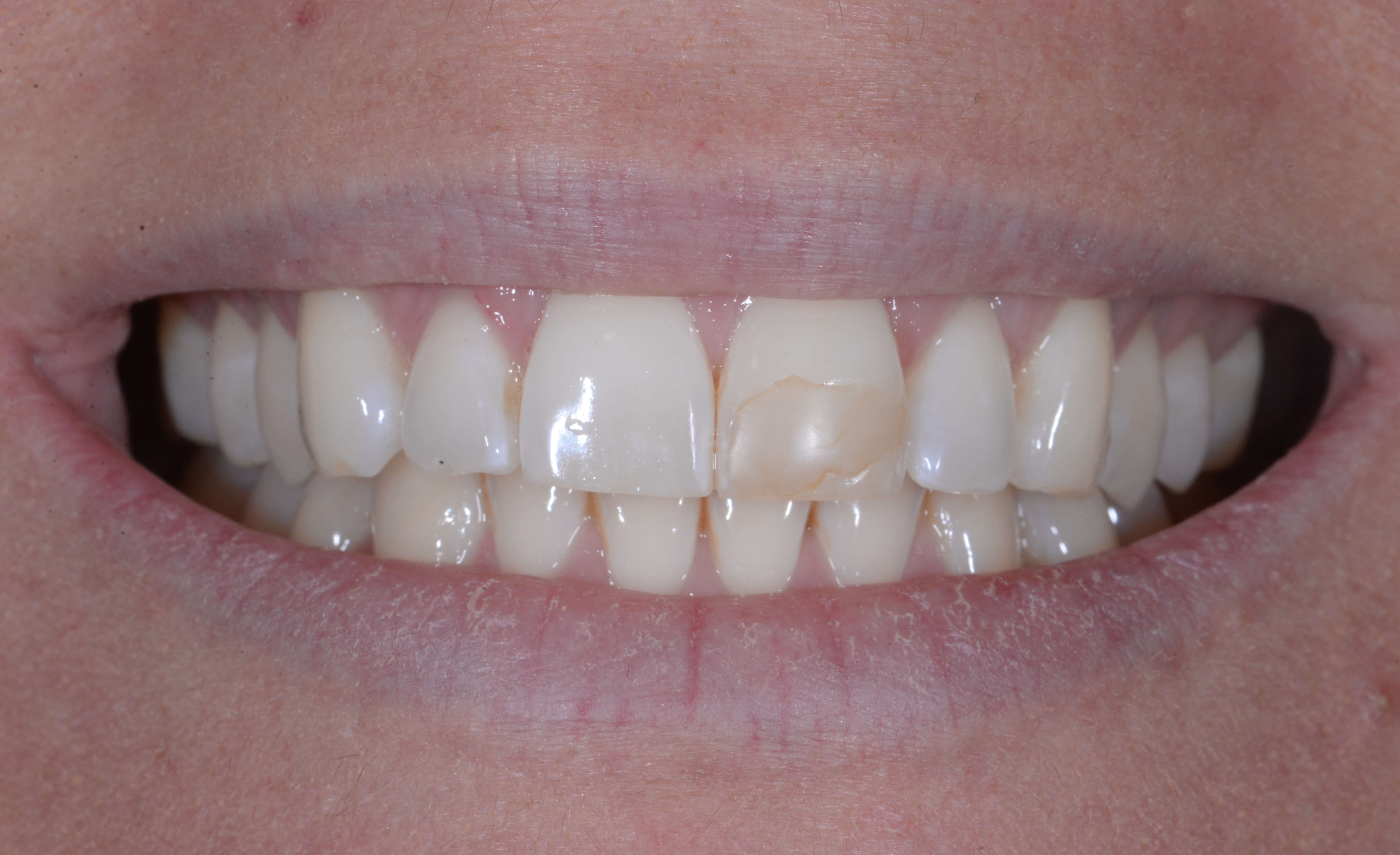 Before and After Zoom Whitening & Cosmetic Dental Bonding Photos How To Whiten Bonded Teeth At Home Before and After Zoom Whitening & Cosmetic Dental Bonding Photos - How To Whiten Bonded Teeth At Home