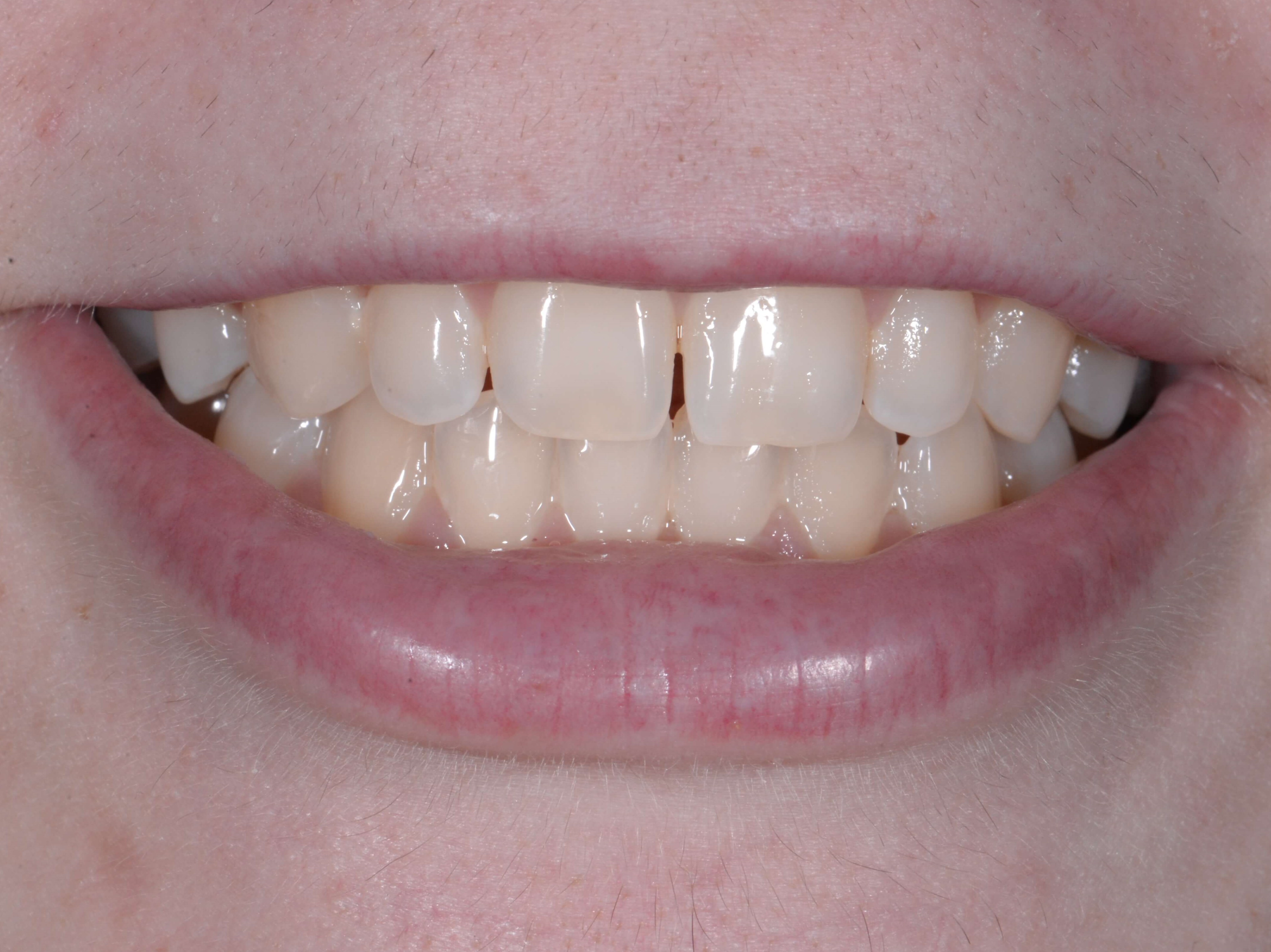 Before and After Zoom Whitening Photos Before and After Zoom Whitening Photos