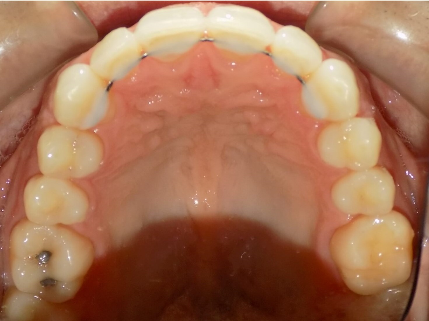 malocclusion overbite invisalign lexington