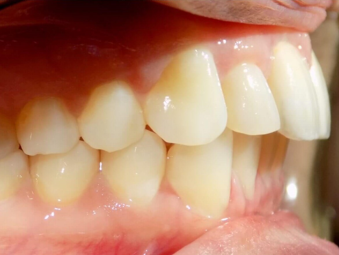 invisalign overbite retainers orthodontic lexington