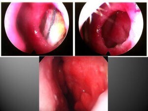 Septal Perforation Before and After Septal Perforation Repair by Dr. Kridel
