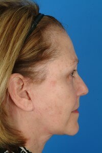 BA_26566_AfterProfile Dr. Kridel patient profile after facelift surgery