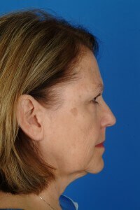 BA_26566_BeforeProfile Dr. Kridel patient before facelift