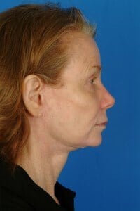 6 Months Post-Op Facelift EB_25406 6 mo postflift