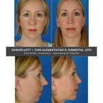 Chin Implant Before/After