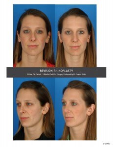 Revision Rhinoplasty Patient of Dr. Russell Kridel