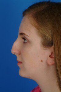 MH_26279_ProfileBeforeUse Rhinoplasty before