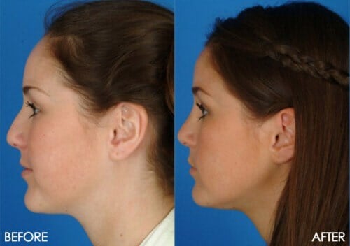 How to choose a revision rhinoplasty surgeon tips How to choose a revision rhinoplasty surgeon