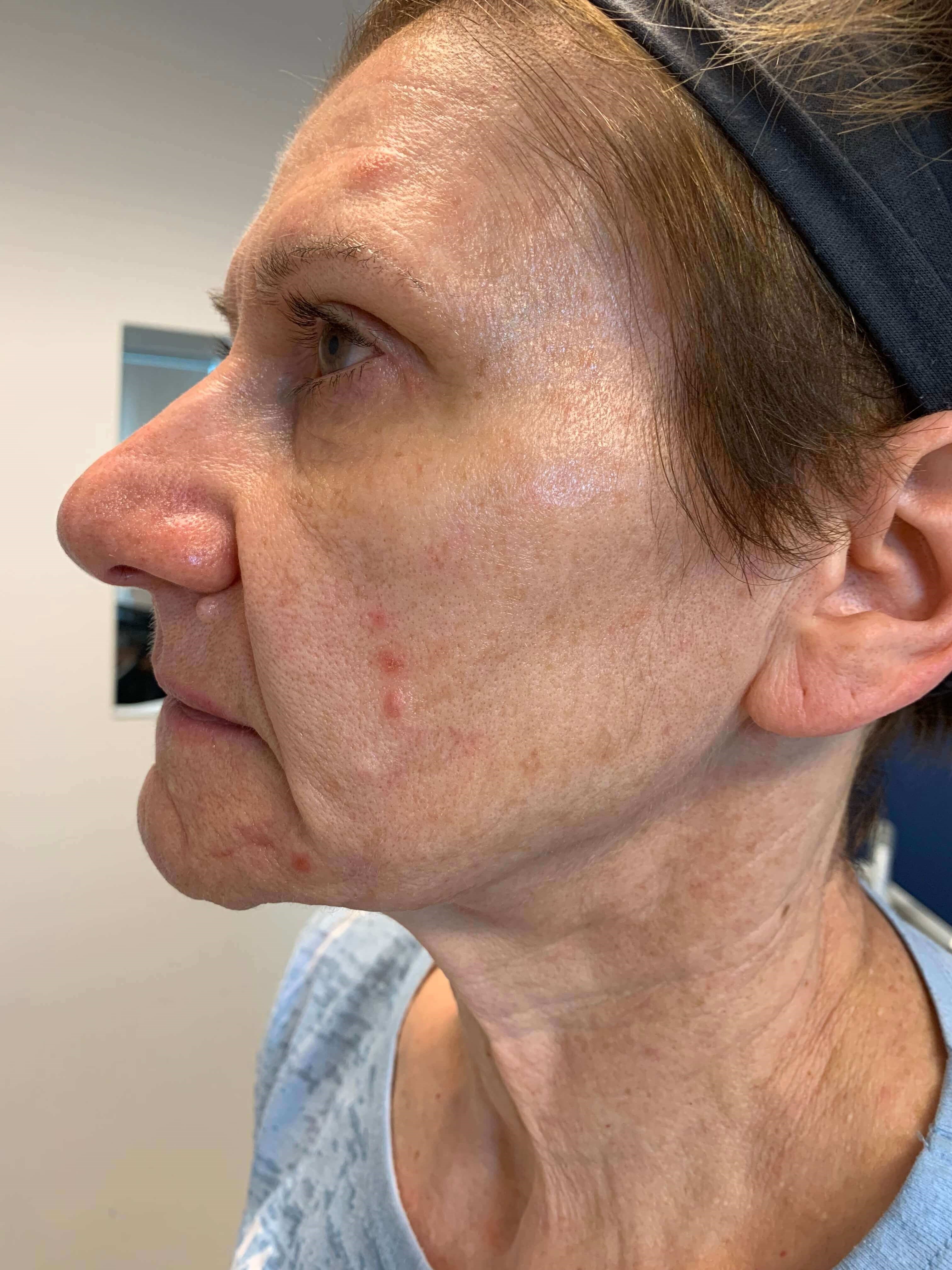 Before and After RF Microneedling Photos