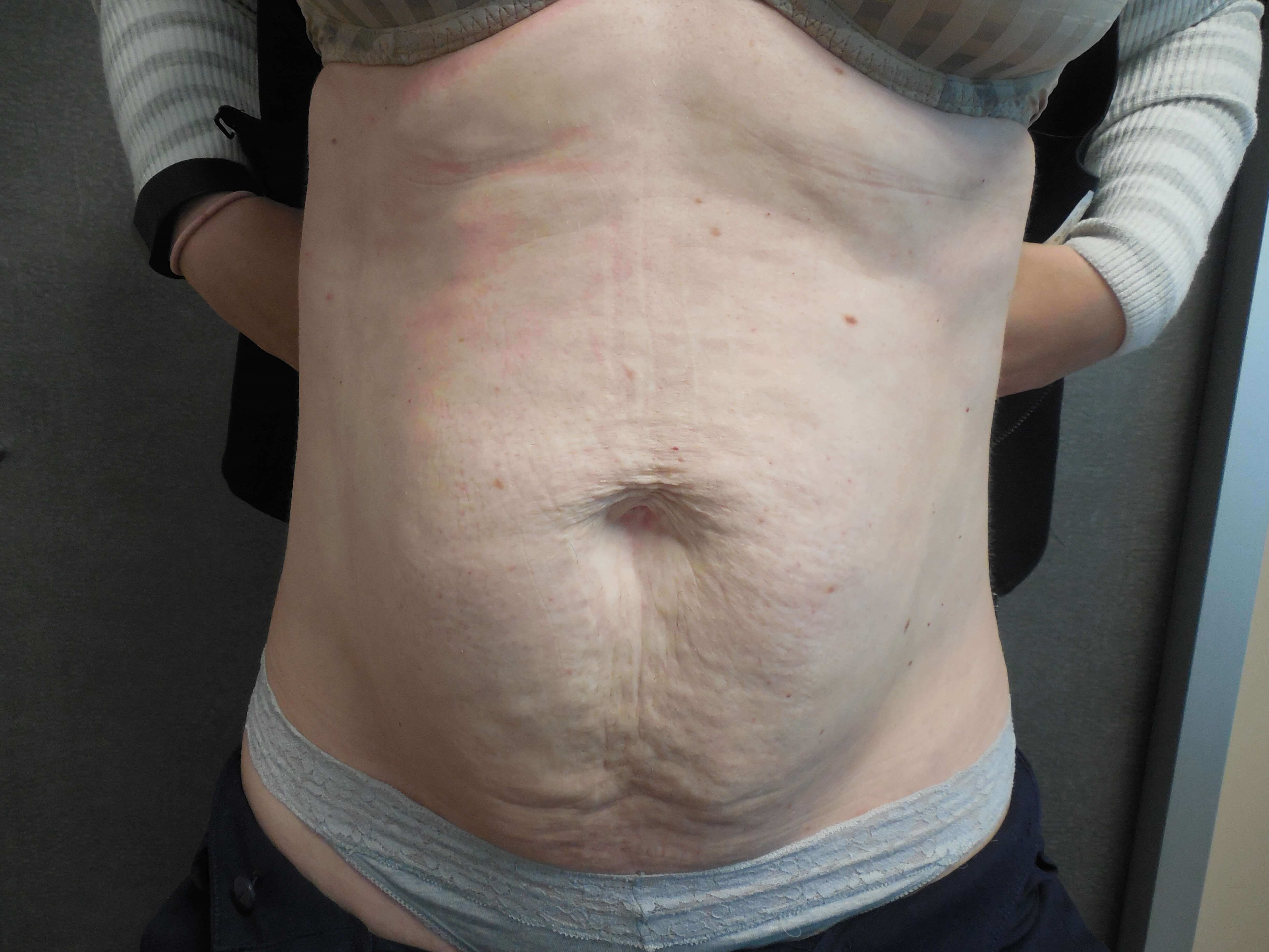 Before and After Tummy Tuck Photos