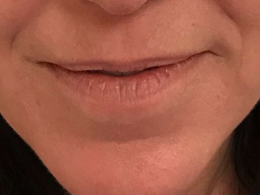 Before and After Juvéderm® & RF Microneedling & Laser Skin Resurfacing